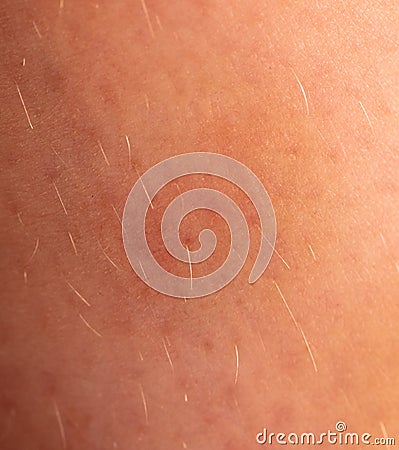 Close-up of a bruise on the skin. Macro Stock Photo