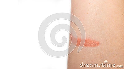 Close up burning skin on arm, Injury from fire. Painful burn marks on arms. Skin Burn Treatment Stock Photo