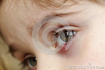Close-up of a child`s eye stye. Ophthalmic hordeolum disease Stock Photo