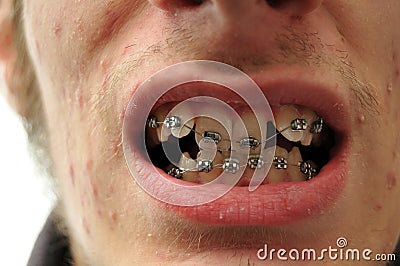 Close up of crooked teeth with braces Stock Photo