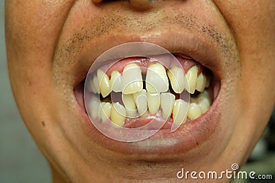 Close up crooked yellow teeth of men Stock Photo