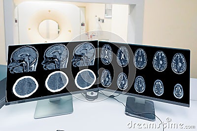Close up CT-scan control room and showing brain image meningioma in brain CT scan room background, Medical healthcare. Stock Photo