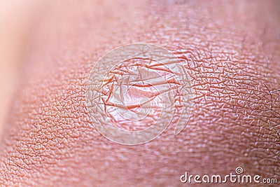 Cyanotic keloid scar caused by surgery and suturing Stock Photo