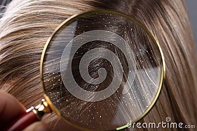 Dandruff In Hair Seen Through Magnifying Glass Stock Photo