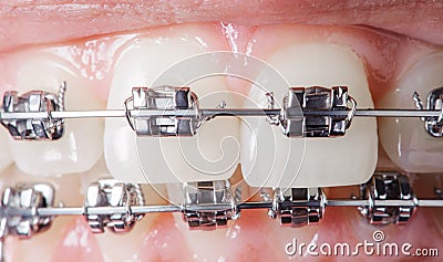 Close-up dental braces on teeth. Orthodontic Treatment Stock Photo