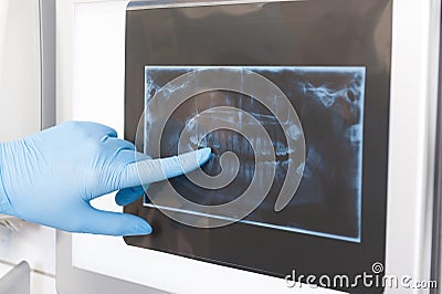 Close-up of dentist showing x-ray to a patient Stock Photo