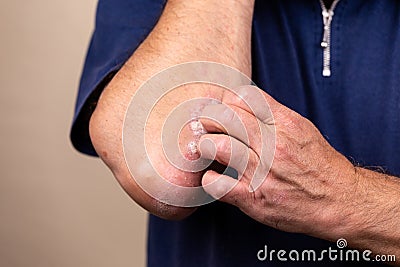 Close up dermatitis on skin, ill allergic rash dermatitis eczema of patient , atopic dermatitis symptom skin detail texture , Stock Photo