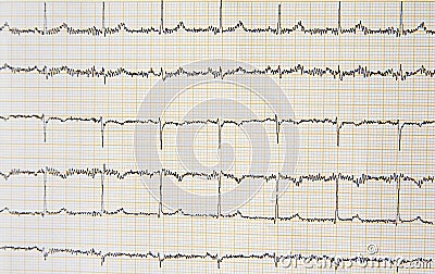 Close up of ECG electrocardiogram paper Stock Photo