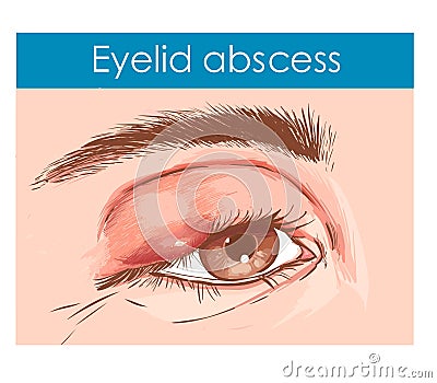 Close up of an eye with an infected eyelid Vector Illustration