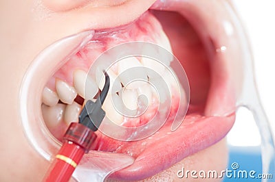 Close up of female mouth with retractor and composite Stock Photo