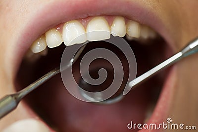 Close-up of female with open mouth during oral checkup at the dentist Stock Photo