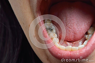 Close up of female patient mouth with decayed tooth. Dental heal Stock Photo