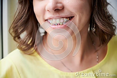 Young woman demonstrating teeth with orthodontic braces. Stock Photo