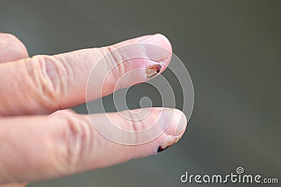 Close up on the fingers of a senior man with healing sores Stock Photo