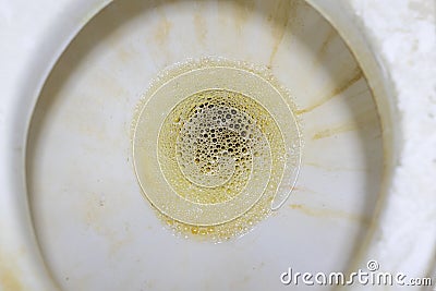 Close-up of foamy urine in the toilet. Stock Photo