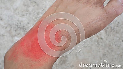 Close up foot gout pateint Stock Photo