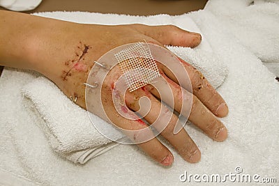 Close up of a Fractured hand with pin fixture Stock Photo