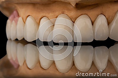 Close-up front view of a dental upper jaw prosthesis on black glass background. Artificial jaw with veneers and crowns Stock Photo