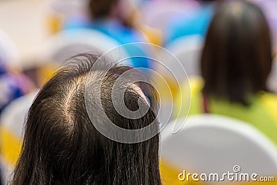 Close up hair loss, thinning hair and scalp issue. hair loss treatment.head with loss symptoms. Stock Photo