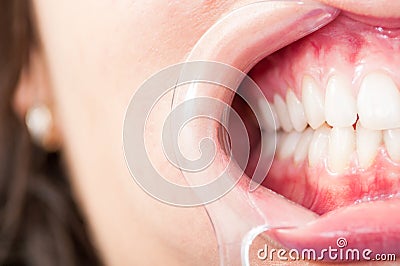 Close-up of half mouth with plastic retractor and teeth Stock Photo