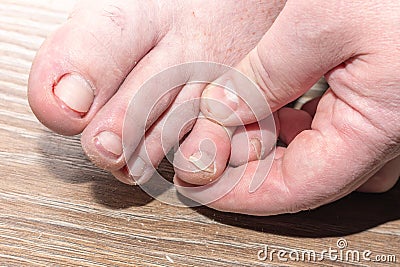 Close-up of a hand holding a man& x27;s feet with ingrown toenails, unhealthy toenails on a wooden background Stock Photo