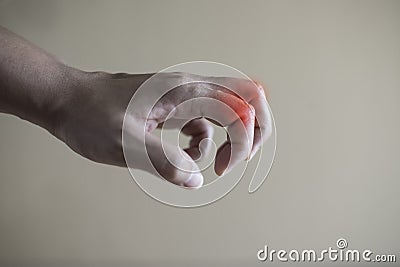 Close up hand rheumatoid arthritis pateint. Stock Photo