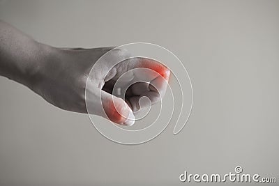 Close up hand rheumatoid arthritis pateint. Stock Photo