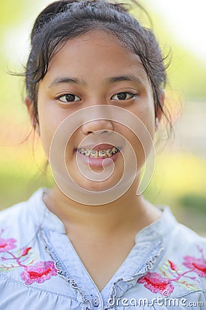 Close up head of asian teen age with braces dental teeth Stock Photo