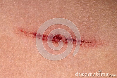 Close-up of a healed scar on skin. Macro shot with copy space. Stock Photo
