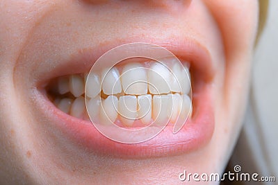 Close up of healthy teeth of young woman. Dental health care. Hygiene teeth. Dentistry Stock Photo