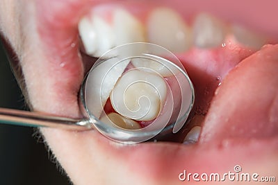Close-up of a human rotten carious tooth at the treatment stage Stock Photo