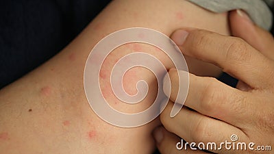 Close up image of arm suffering severe urticaria or hives or kaligata. Hives skin. Stock Photo