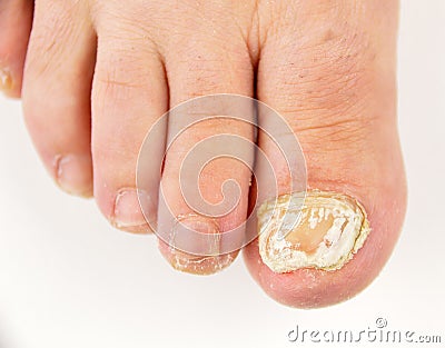 Nail fungus Stock Photo