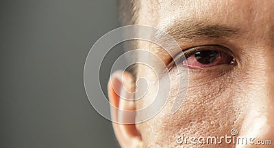 Irritated red bloodshot male eye. Stock Photo