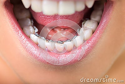 Close up of lingual braces Stock Photo