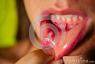 Close - up on the lip with aphthous stomatitis Stock Photo