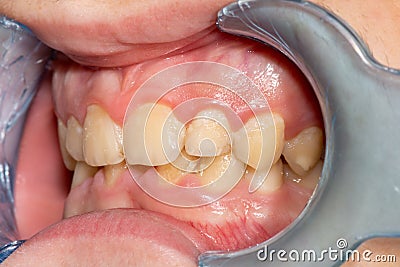 Close-up of macro dental calculus and dental plaque. Oral hygiene in dentistry Stock Photo
