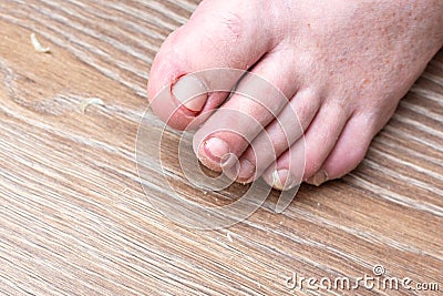 Close-up of a male foot with ingrown toenails, unhealthy toenails on a wooden background. Healthy nails concept Stock Photo