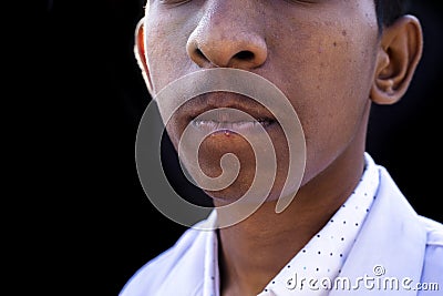 Close-up of man lips suffering from herpes disease Stock Photo