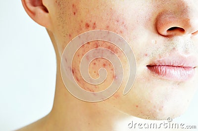 Close up of man with problematic skin and scars from acne. Stock Photo