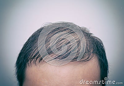 Close up man`s head with hair loss, thinning hair or alopecia isolated on white background with old analog film effect. Hair Stock Photo