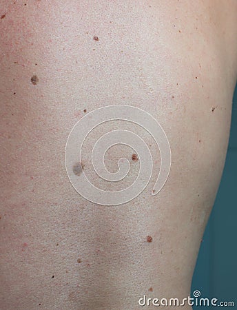 Close up the melanoma black spot on human skin. Stock Photo