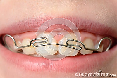 Close-up of a metal plate in the mouth on the teeth of a little boy Stock Photo