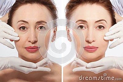 Close up middle age woman macro face before after collagen injection. Face lifting, anti aging concept. Plastic surgery, cosmetic Stock Photo