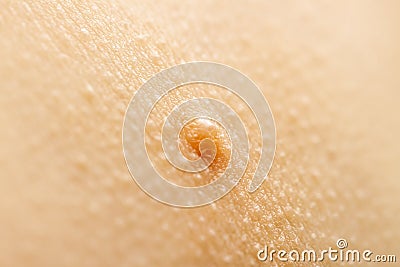 Close up of Molluscum Contagiosum also called water wart Stock Photo
