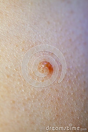Close up of Molluscum Contagiosum also called water wart Stock Photo