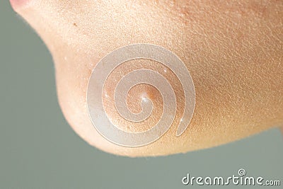 Close-up of Molluscum Contagiosum also called water wart. Viral formations in the chin on the skin of the child Stock Photo