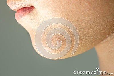 Close-up of Molluscum Contagiosum also called water wart. Viral formations in the chin on the skin of the child Stock Photo