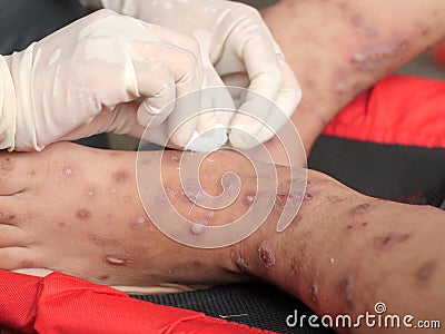Nurse hand cleaning patient foot with ulcer filled with pus condition caused of scabies infection, sensitive skin itchy health Stock Photo
