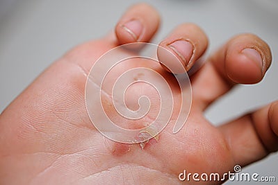 A close-up of the palm of my hand after a hard workout,A lacerated callus on the palm of my hand Stock Photo